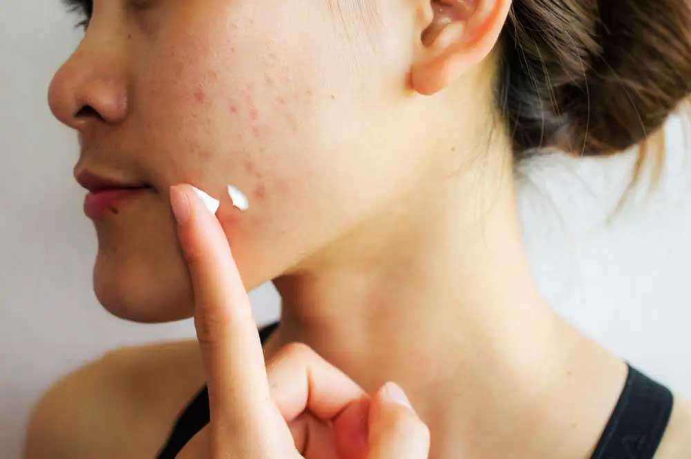 Tips for choosing a moisturizer for acne-prone skin