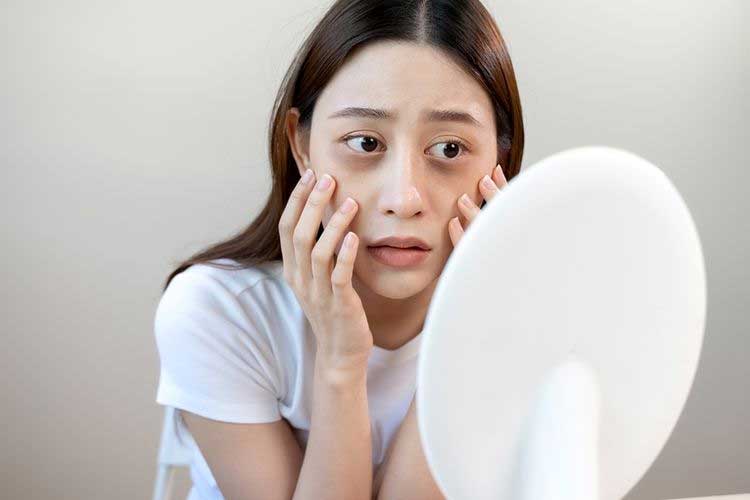 How to Get Rid of Dark Eye Bags Permanently