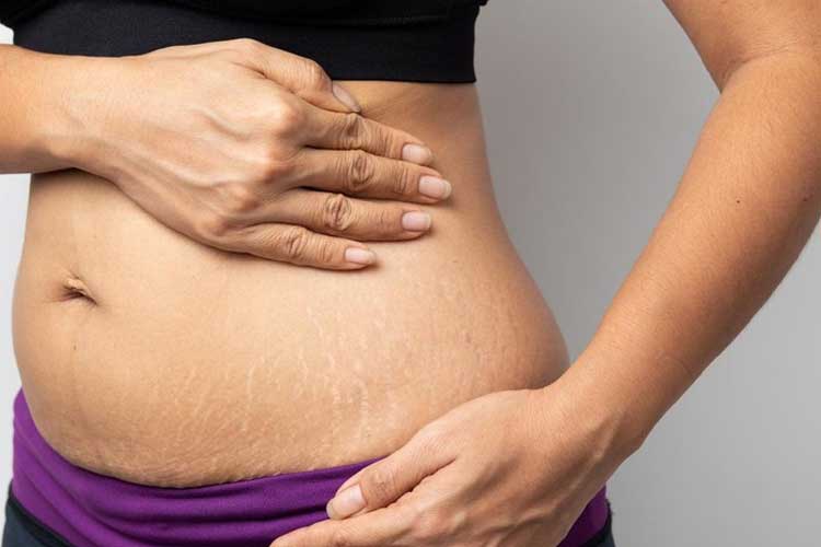 How to Remove Stretch Marks Using 11 Natural Ingredients