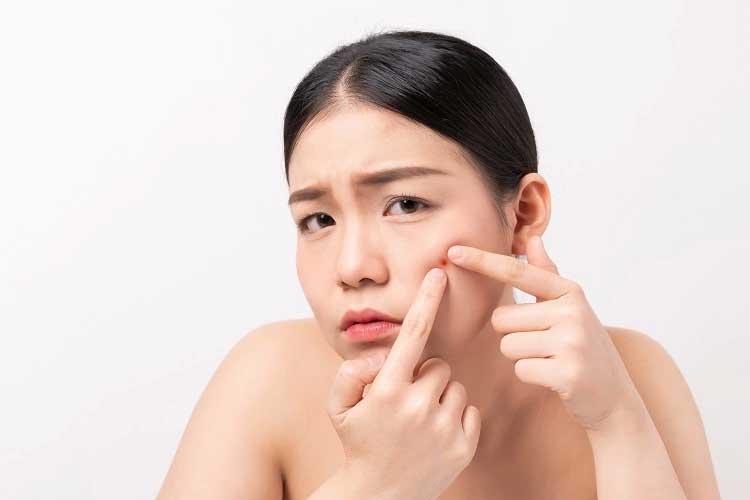 Note, this is how to prevent acne from growing again
