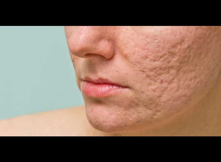 There are pockmarked acne scars, here's how to get rid of them