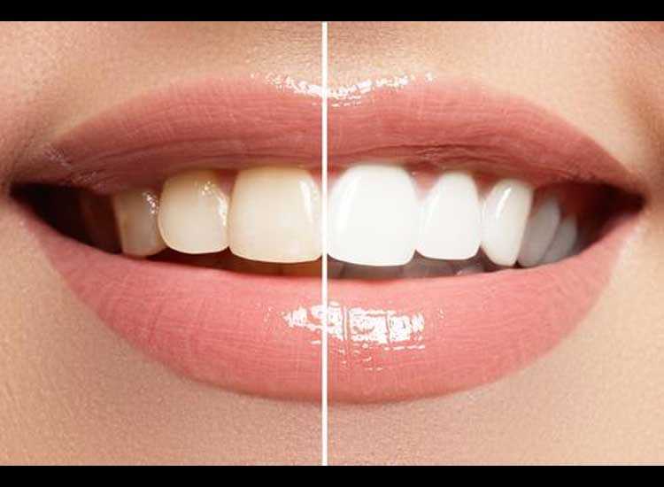 Is there a way to whiten teeth naturally?