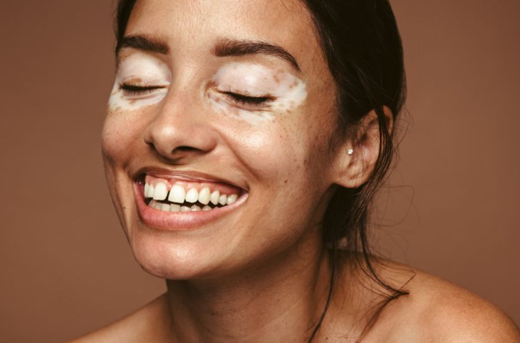 How to Treat Vitiligo, Including Using Sunscreen