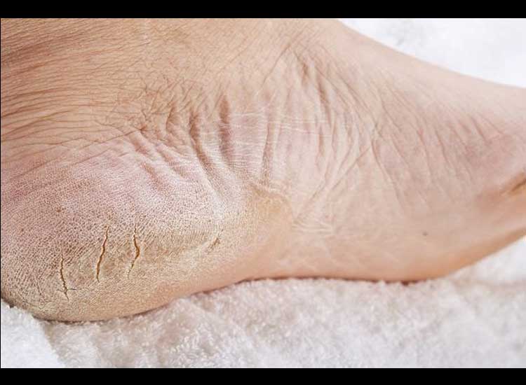 Cracked Feet, Here's What You Can Do