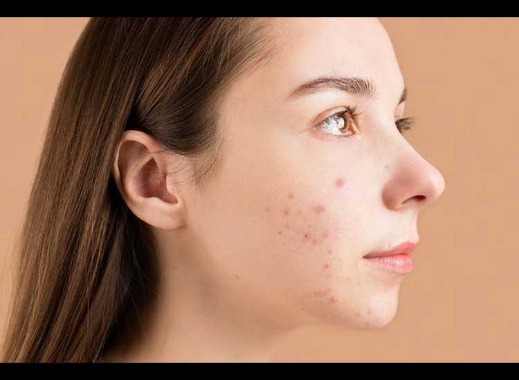 5 Ways to Prevent Acne Naturally for a Beautiful, Radiant Face